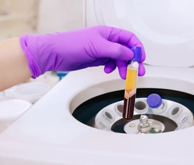 PRP vs Stem Cell